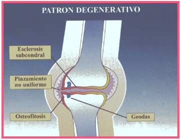 Pautas y procedimientos en Medicina Interna. Osteoartrosis u osteoartritis  - Revista Electrónica de PortalesMedicos.com