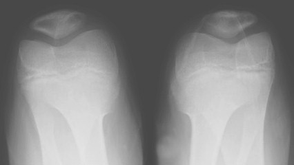 Tecnicos Radiologos: Radiografía Axial de Rótula. Variantes