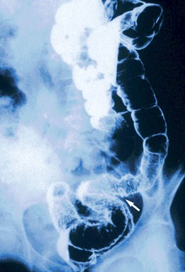 Enfermedad de Crohn y Colitis Ulcerativa o Ulcerosa - Revista Electrónica  de PortalesMedicos.com