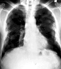 http://portalesmedicos.com/images/publicaciones/mesotelioma_pulmonar